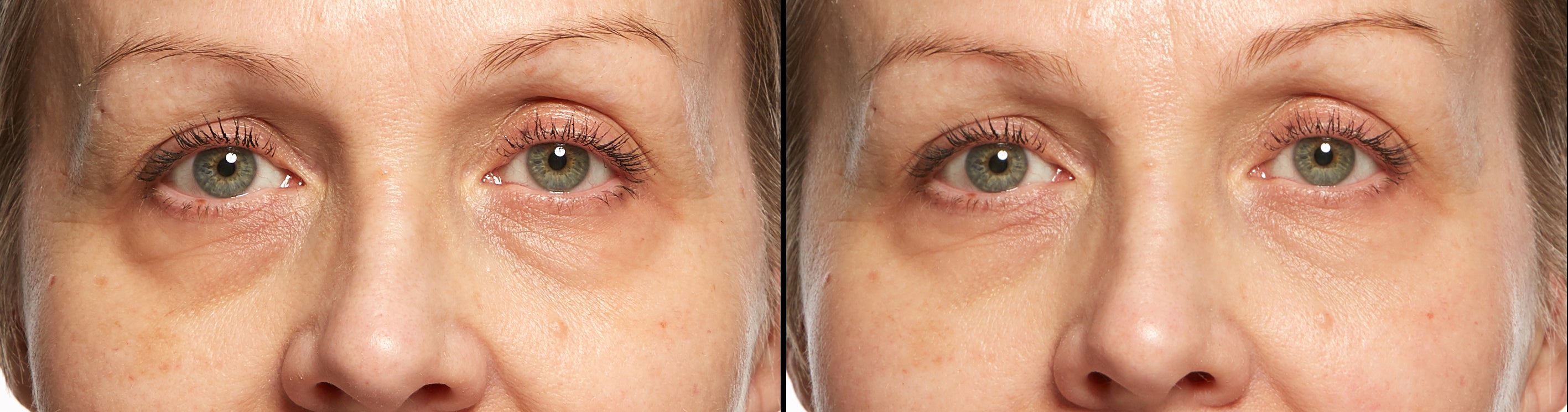 ELYSIUM SUPRA-ORBITAL MASK