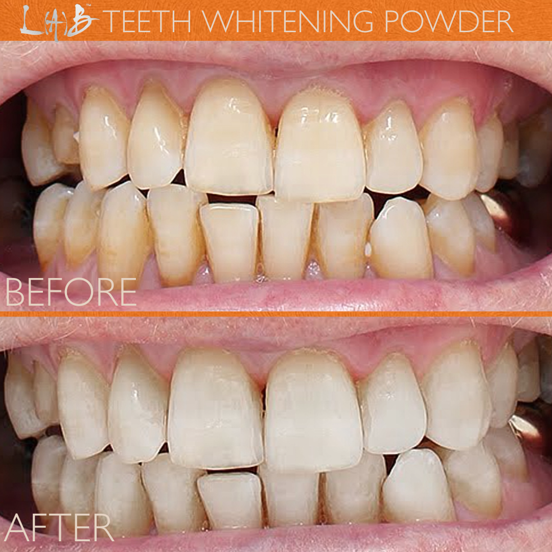 TEETH WHITENING POWDER