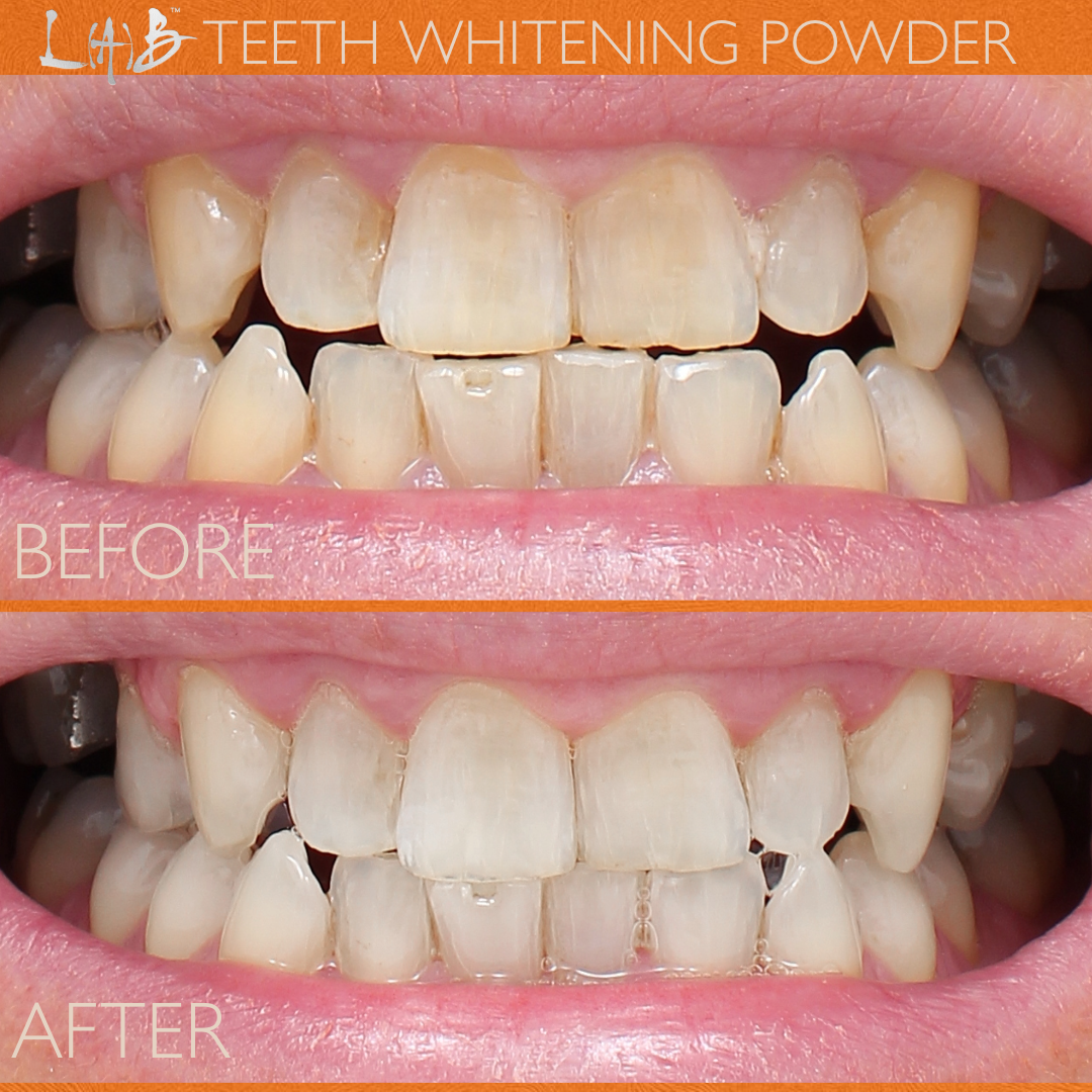 TEETH WHITENING POWDER