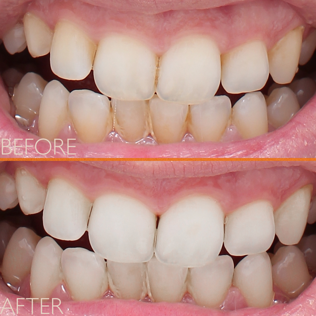 FLOSS LIGHT REPLACEMENT HEADS