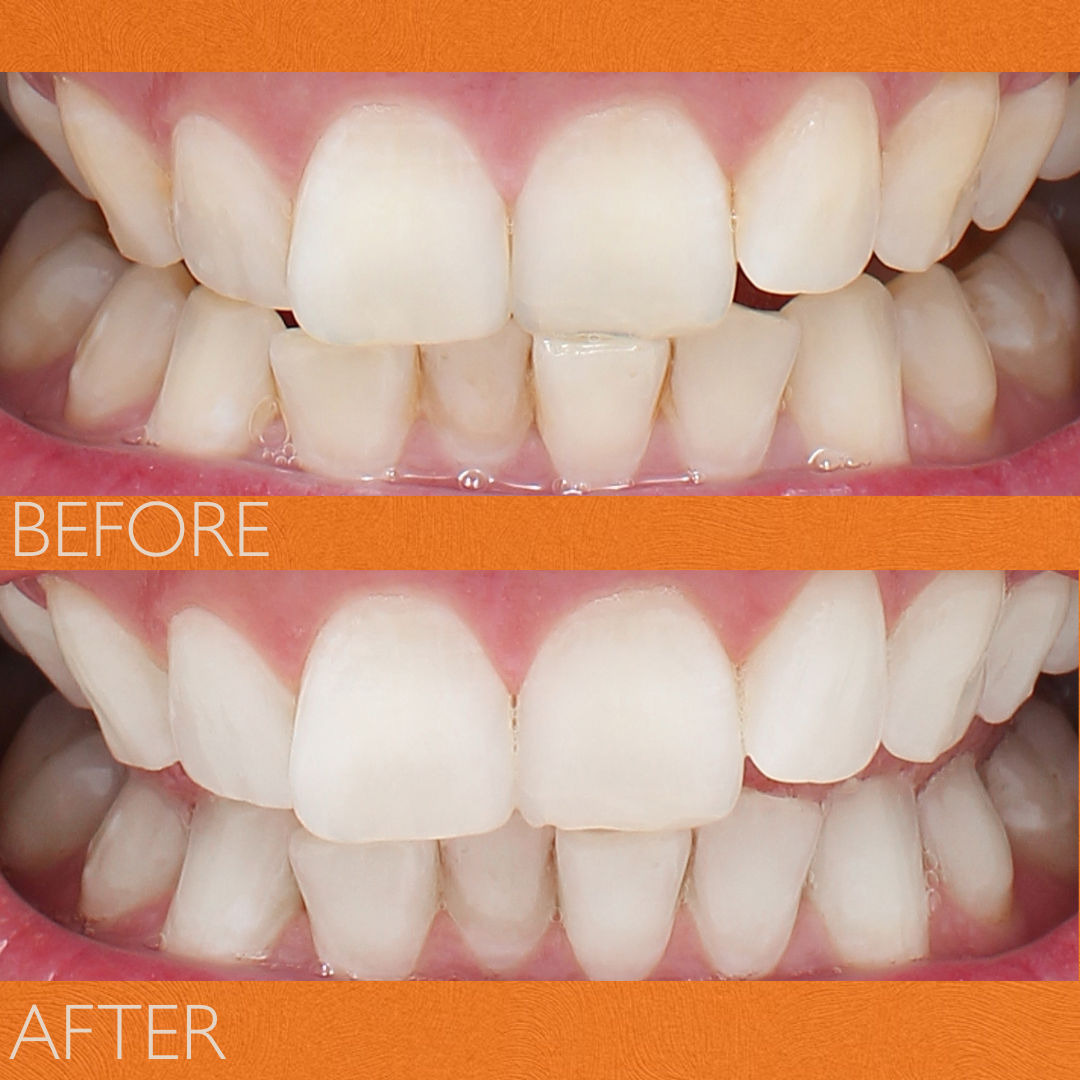 FLOSS LIGHT REPLACEMENT HEADS