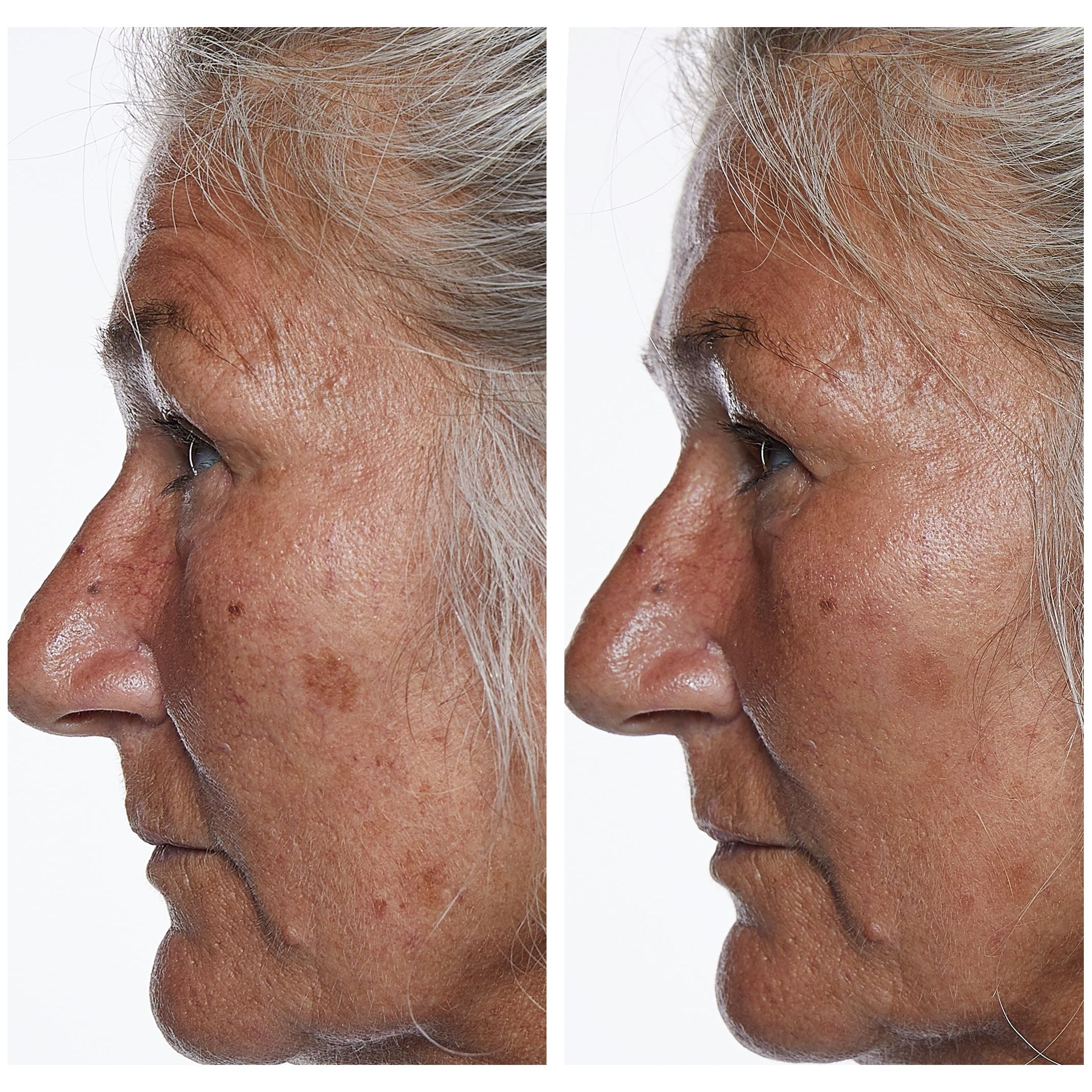 Photonic Cleansing Brush