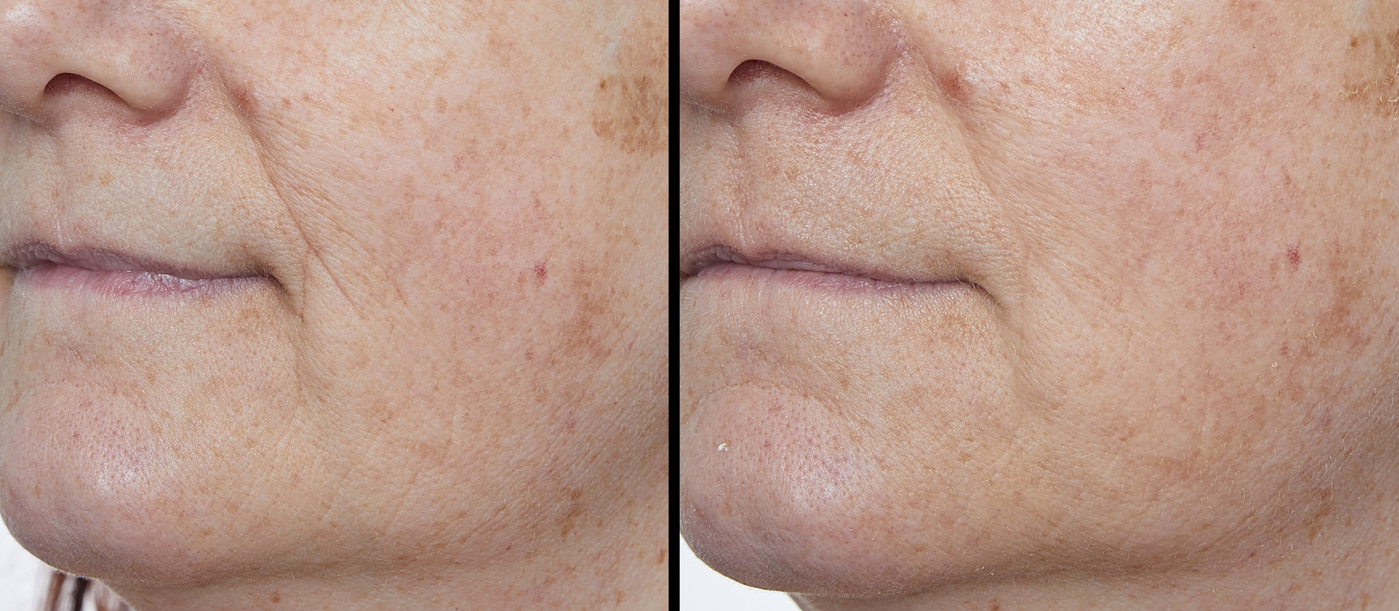 PHOTON TARGETED RESULTS