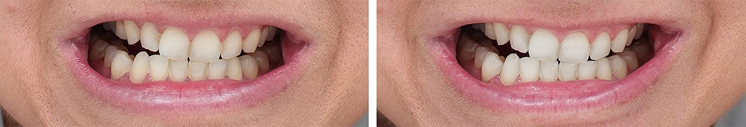 FORTUS UV TOOTHBRUSH