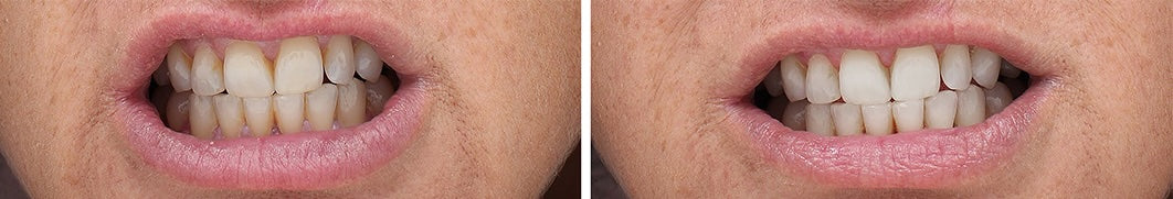 FORTUS UV TOOTHBRUSH