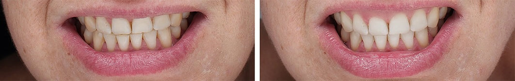 FORTUS UV TOOTHBRUSH