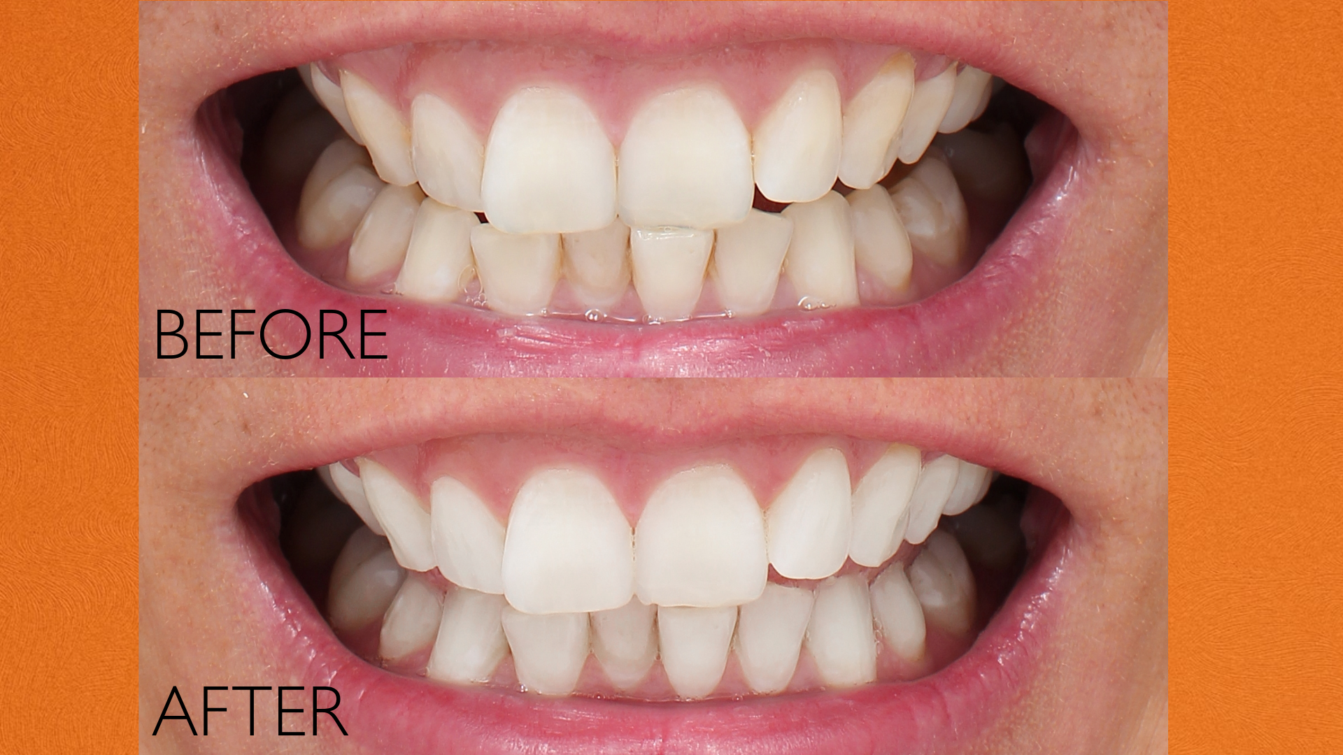 FORTUS UV TOOTHBRUSH