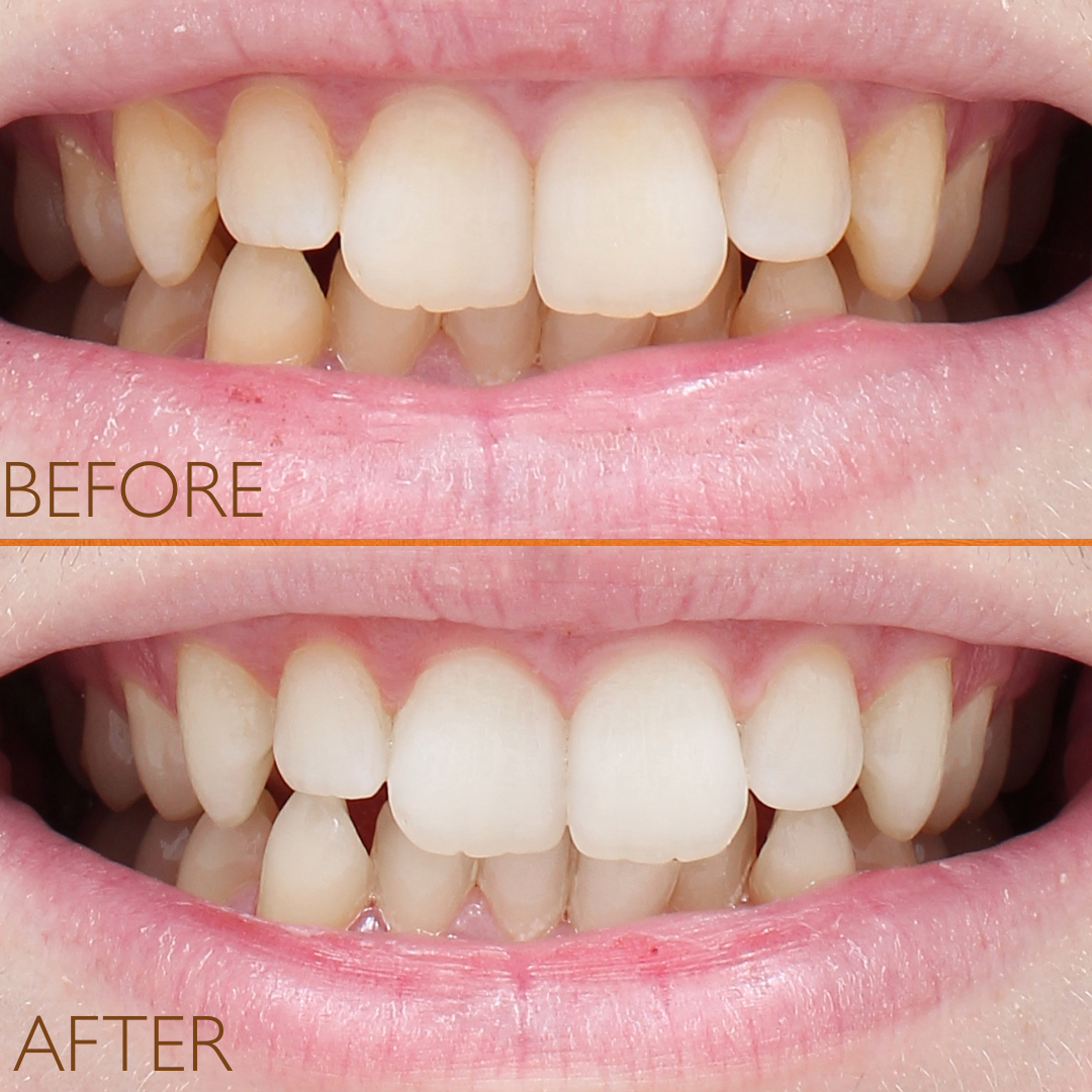 ECLIPSE TEETH WHITENING SYSTEM – L(A)B=LIFE+BEAUTY