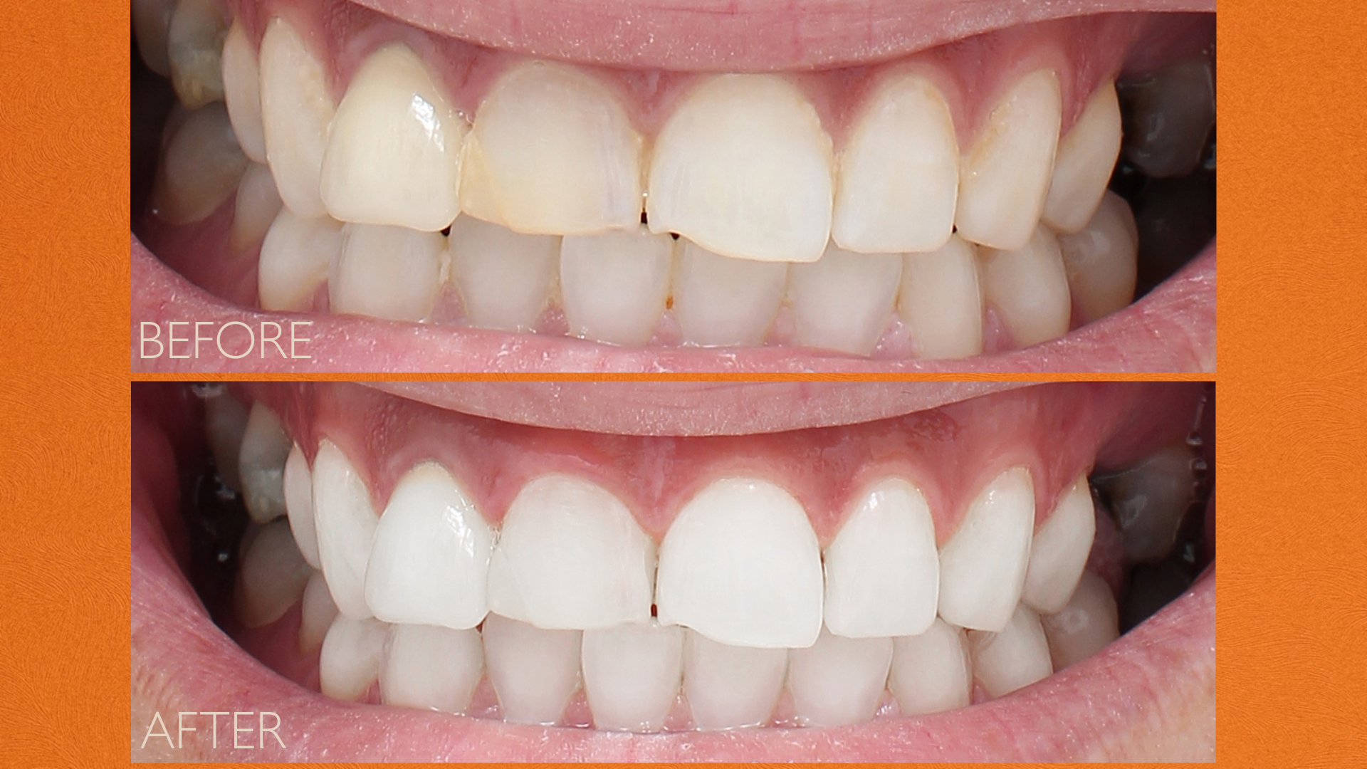 ECLIPSE TEETH WHITENING SYSTEM