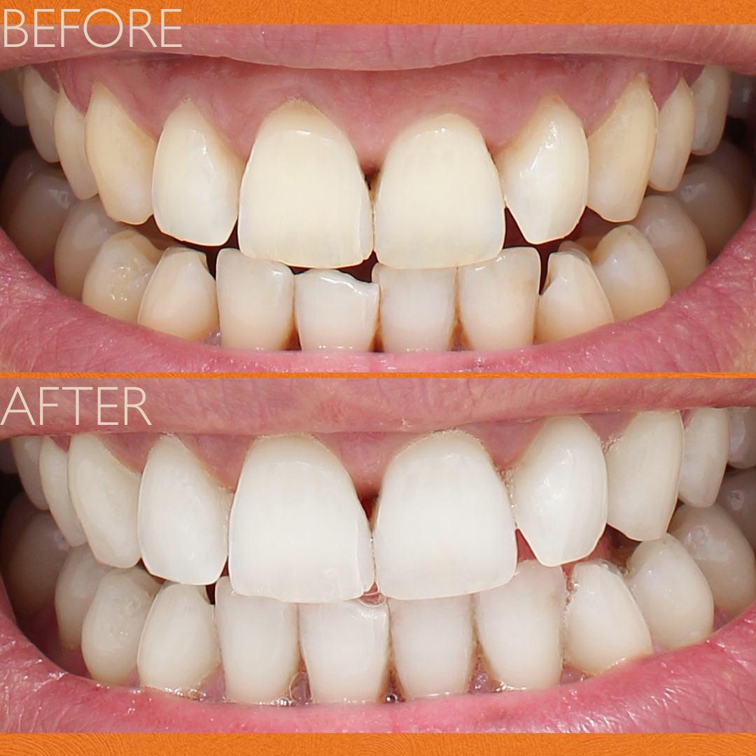 ECLIPSE TEETH WHITENING SYSTEM