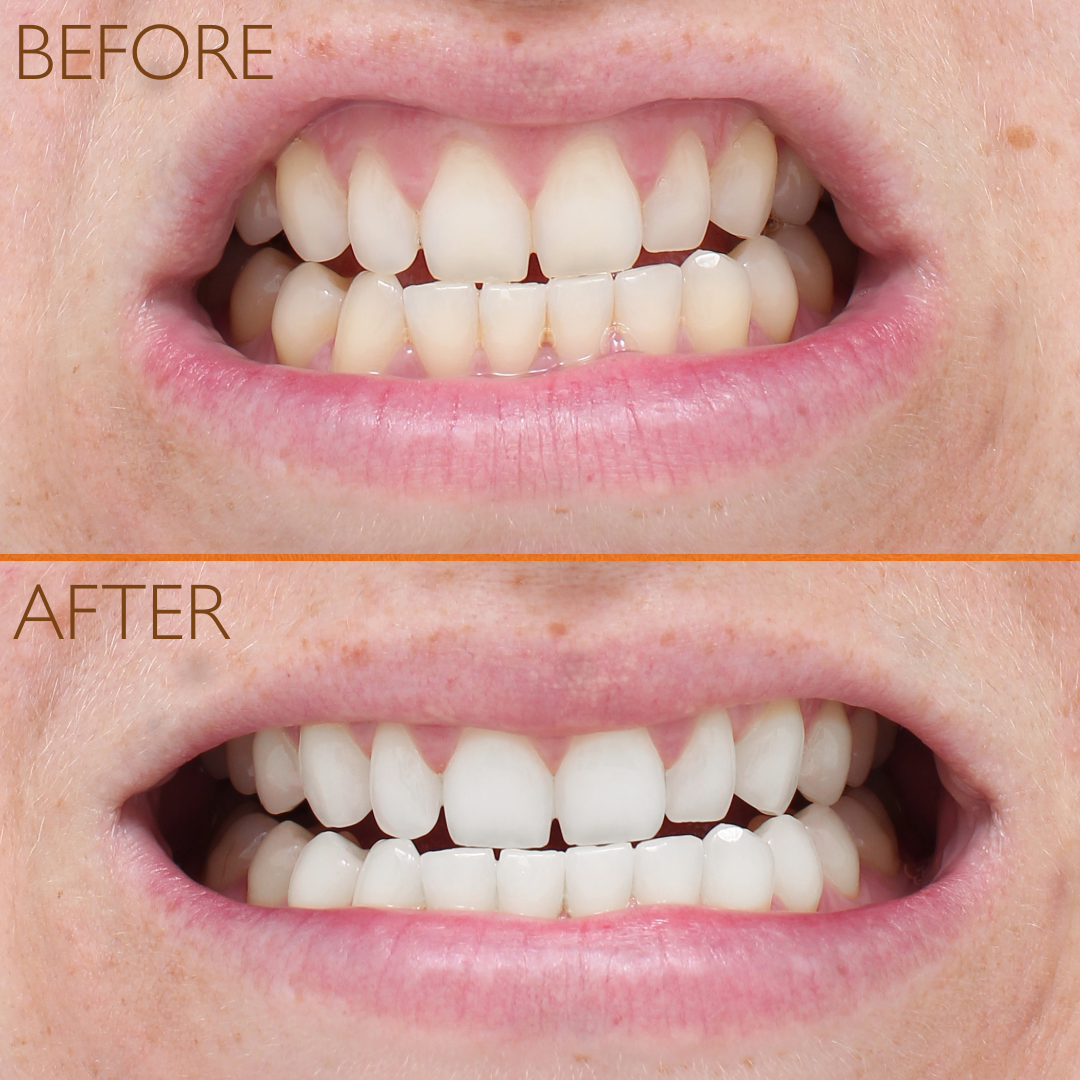 ECLIPSE TEETH WHITENING SYSTEM – L(A)B=LIFE+BEAUTY