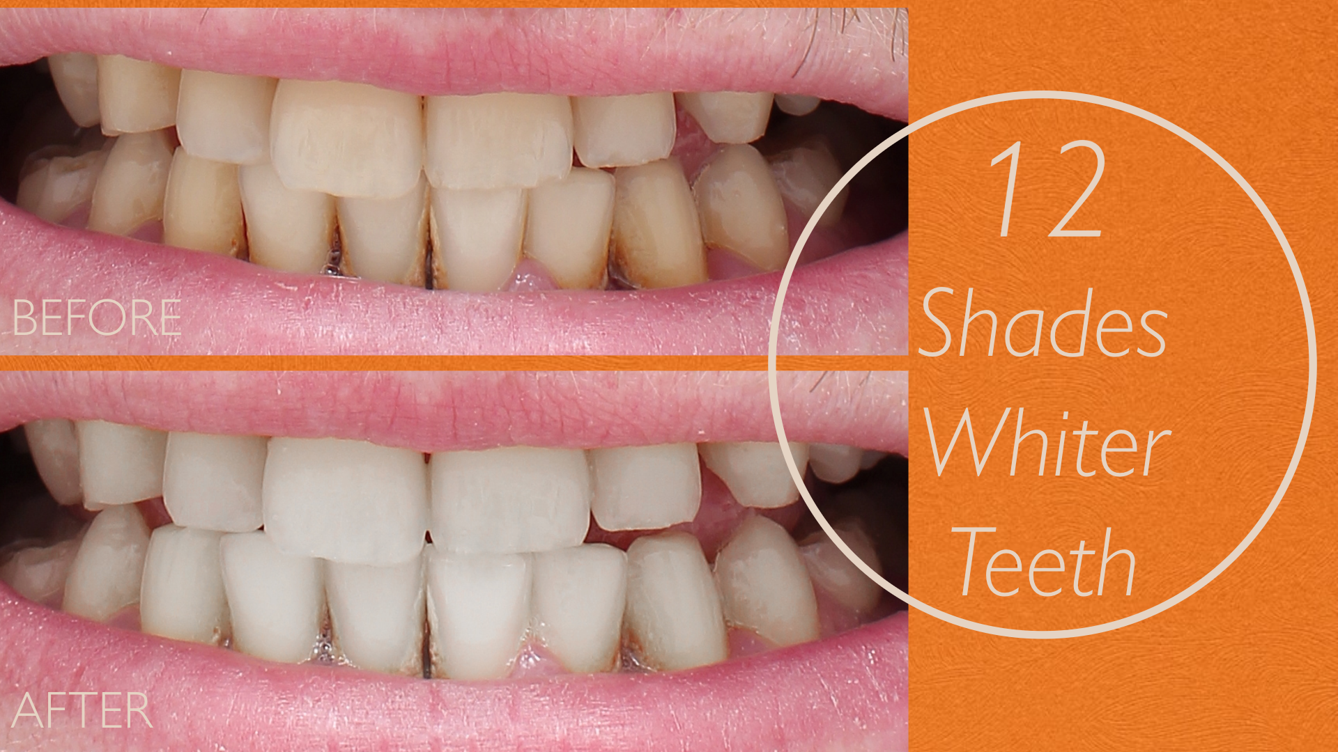 ECLIPSE TEETH WHITENING SYSTEM