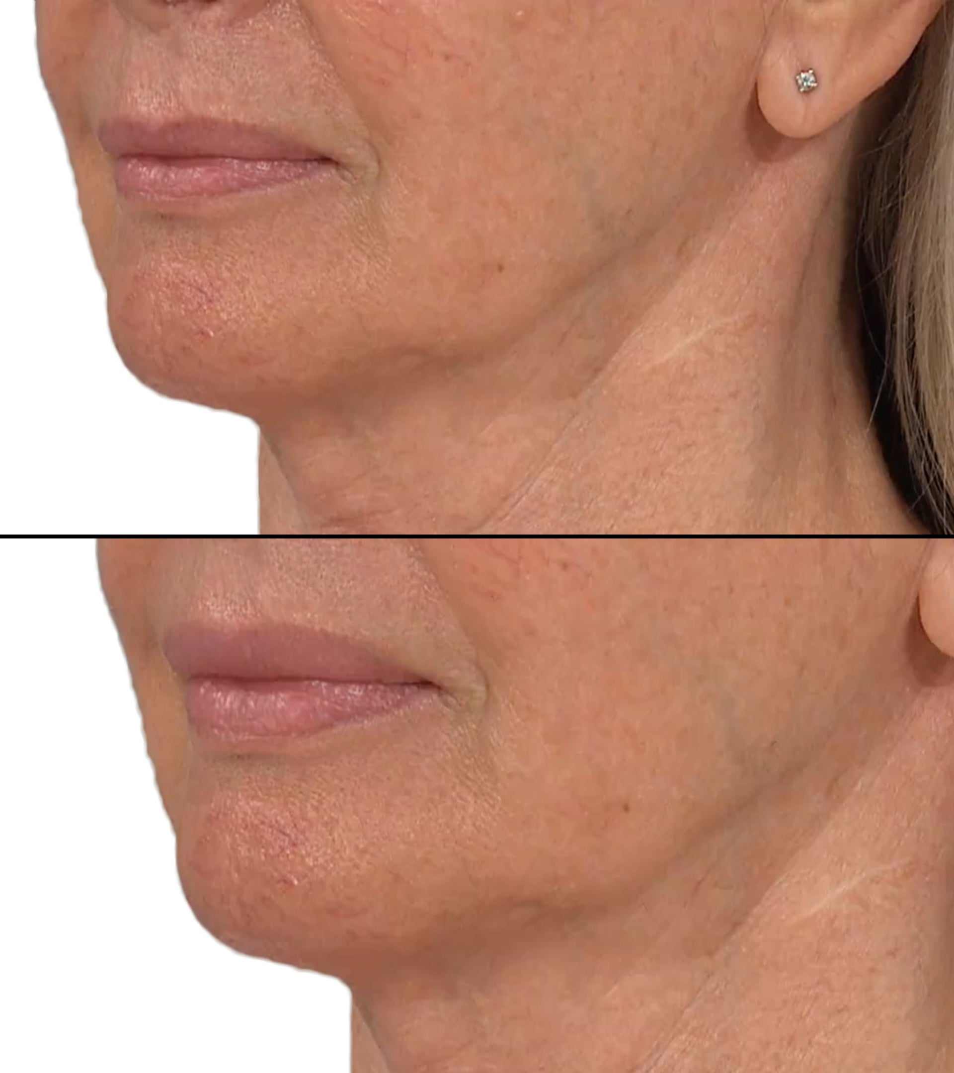 LIP PLUMPER WITH LAB LINES