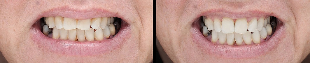 FORTUS UV TOOTHBRUSH